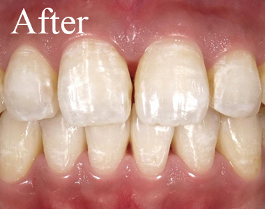 SHINE DENTAL CLINIC のSMILE SHINE WHITENING の 術後　透明感のある白い歯に変化！
